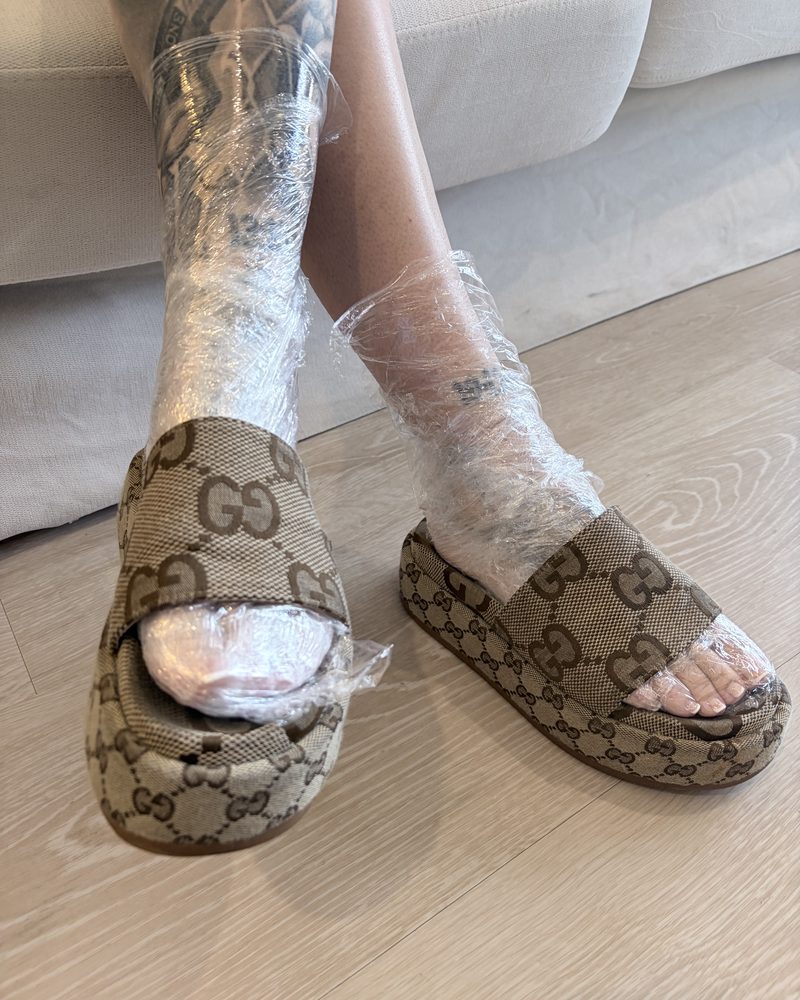 Feet and ankles wrapped in cling film over numbing cream, applied about an hour and a half before treatment