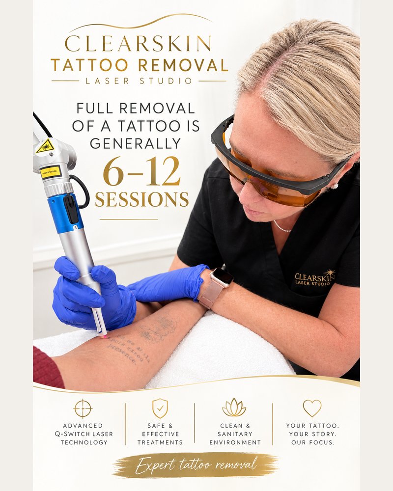 Full removal of a tattoo is generally 6 to 12 sessions